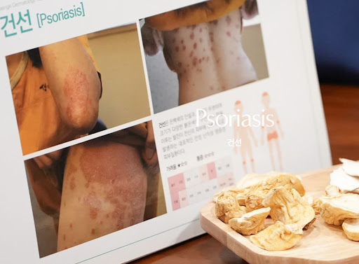 생기한의원 건선 정보, 증상 지속 시 확인하면 좋은 기본 내용